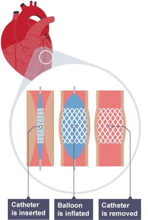 Diagram illustrating how stents work inside arteries