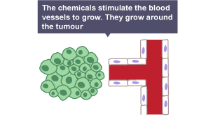 Diagram showing how the blood vessels grow around a tumour