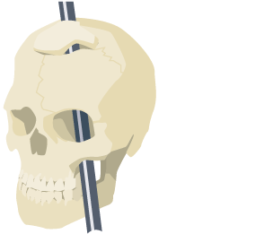 The visual should show an iron rod going through the top of a skull. It will be acting as a example of brain damaged that Phineas Gage suffered in 1848.