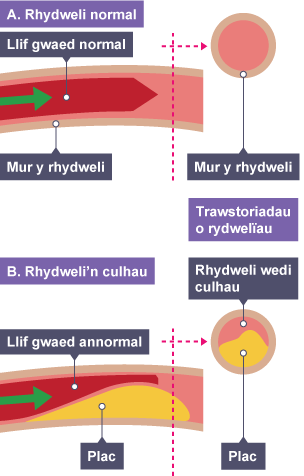 Trawstoriad drwy ddwy rydweli, un wedi'i labelu'n 'Rhydweli normal', y llall yn 'Rhydweli'n culhau'. Mae'r diagram yn dangos sut mae plac yn achosi llif gwaed annormal os yw'n cronni mewn rhydwelïau.