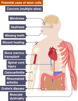 Stem cells could potentially be used to treat illnesses such as cancers, blindess, deafness, missing teeth, wound healing, bone marrow transplant, spinal chord injury, osteoarthritis, rheumatoid arthritis, Crohn's disease and muscular dystrophy.