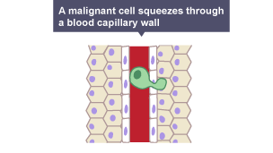 Diagram of a malignant cell squeezing through a capillary wall