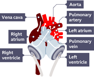 An illustration of an artificial heart