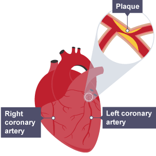 Diagram of a heart with the left and right coronary arteries labelled. A zoomed section shows plaque building up on the walls of the left coronary artery.