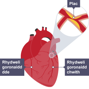 Diagram o galon â'r rhydwelïau coronaidd chwith a de wedi'u labelu. Mae rhan wedi'i chwyddo'n dangos plac yn cronni ar waliau'r rhydweli goronaidd chwith.