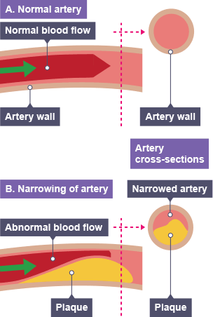 A: normal artery with good blood flow. B: narrow artery with abnormal blood flow, blocked by a think layer of plaque.