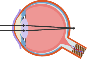 Diagram showing how the light focuses beyond the retina in long sight