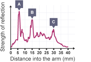 A graph showing the results of an ultrasound. It shows the strength of the reflection against the distance into the arm.