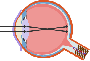 Diagram of how a short-sighted eye focuses before the retina