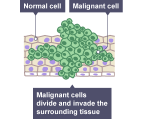 Image shows how malignant cells can divide and invade normal cells.