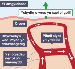 Diagram o rydwelï â'r bibell siynt wedi'i labelu. Mae ysgogiadau nerfol yn dod o'r ymennydd ac mae'r rhydwelï yn darwasgu wrth i'r bibell siynt ymagor. Does dim llawer o wres yn cael ei golli.