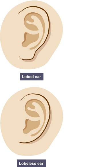 Diagram showing the difference between a lobed ear and a lobeless ear