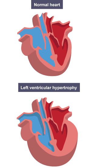 A normal heart and a heart with muscular hypertrophy, where the left ventricular wall has thickened as a result of exercise.