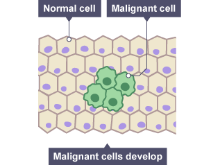 This shows how cancer cells can invade surrounding tissue.