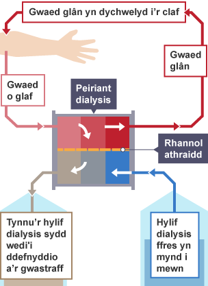 Diagram yn dangos sut mae peiriant dialysis yn gweithio.