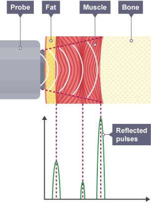 An ultrasound medical scanner. A probe emits ultrasound into fat, muscle and bone. Pulses are reflected at certain points.