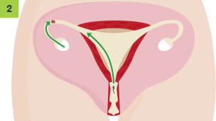 The egg cell is released from the ovary into the oviduct. A sperm has been ejaculated into the vagina and is travelling up the cervix.