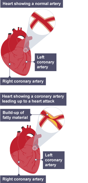 Diagram comparing a healthy artery in the heart vs a blocked artery