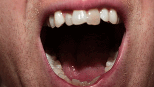 Photograph of person's mouth in extreme close up